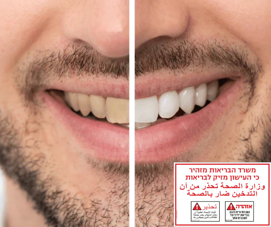 כתמים על השיניים אצל מעשנים: מה באמת עוזר ומה לא